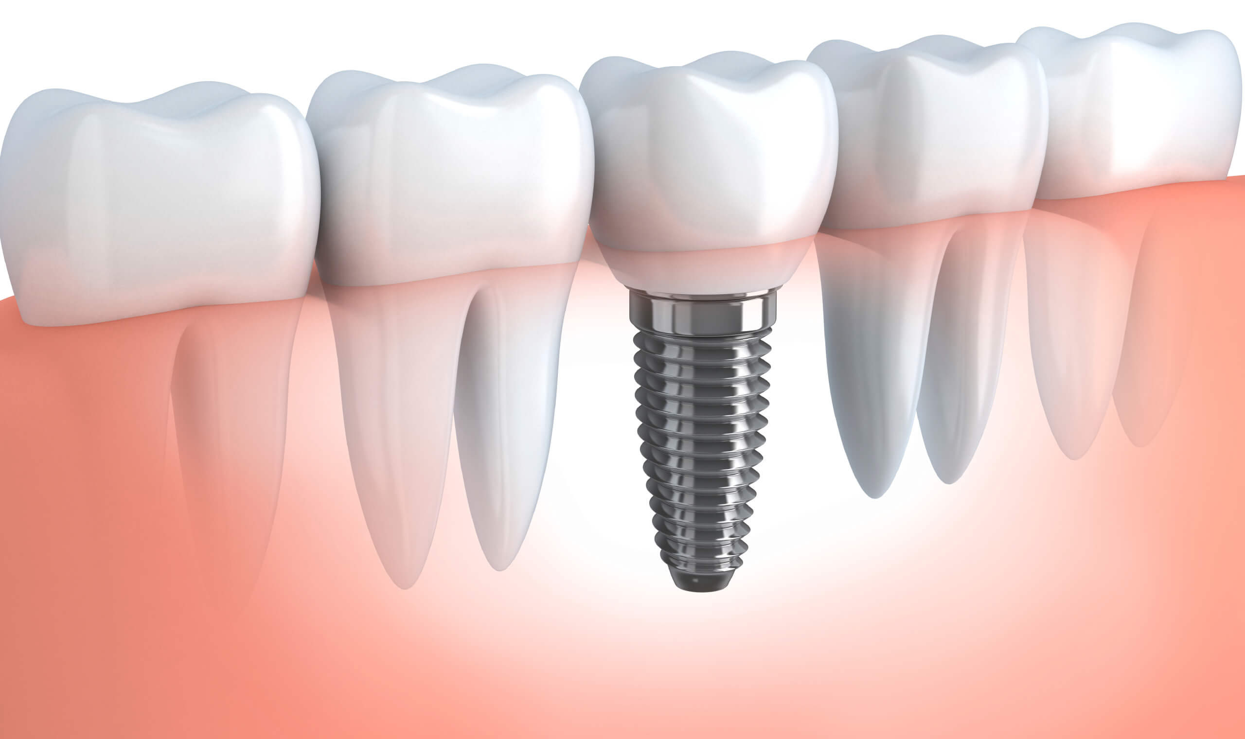 Dental Implant Renfrew