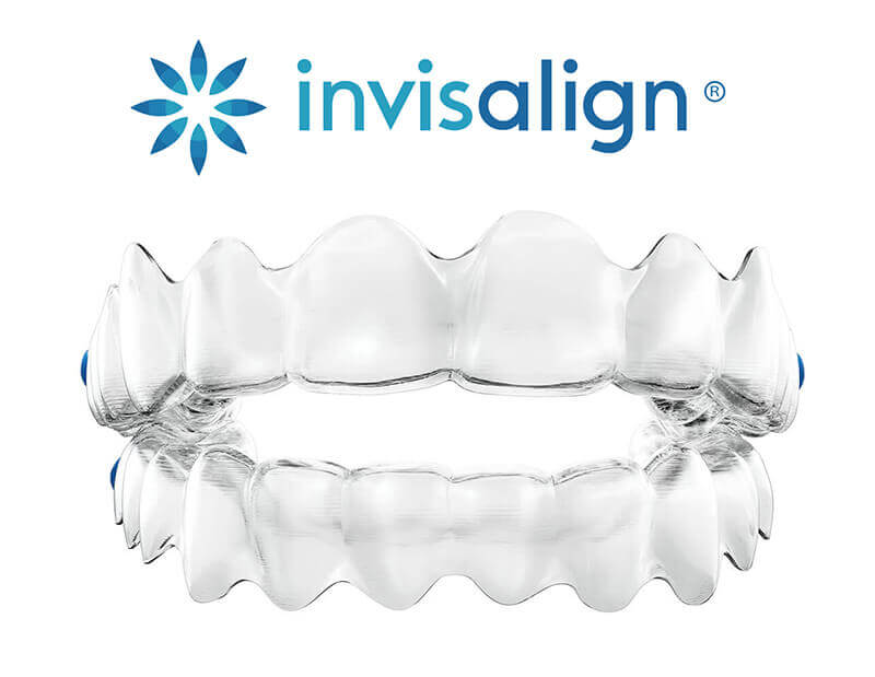 Metal Braces versus Clear Aligners - University General Dentists